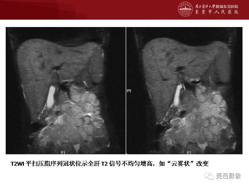 【病例】马尔尼菲蓝状菌感染1例影像学表现-24