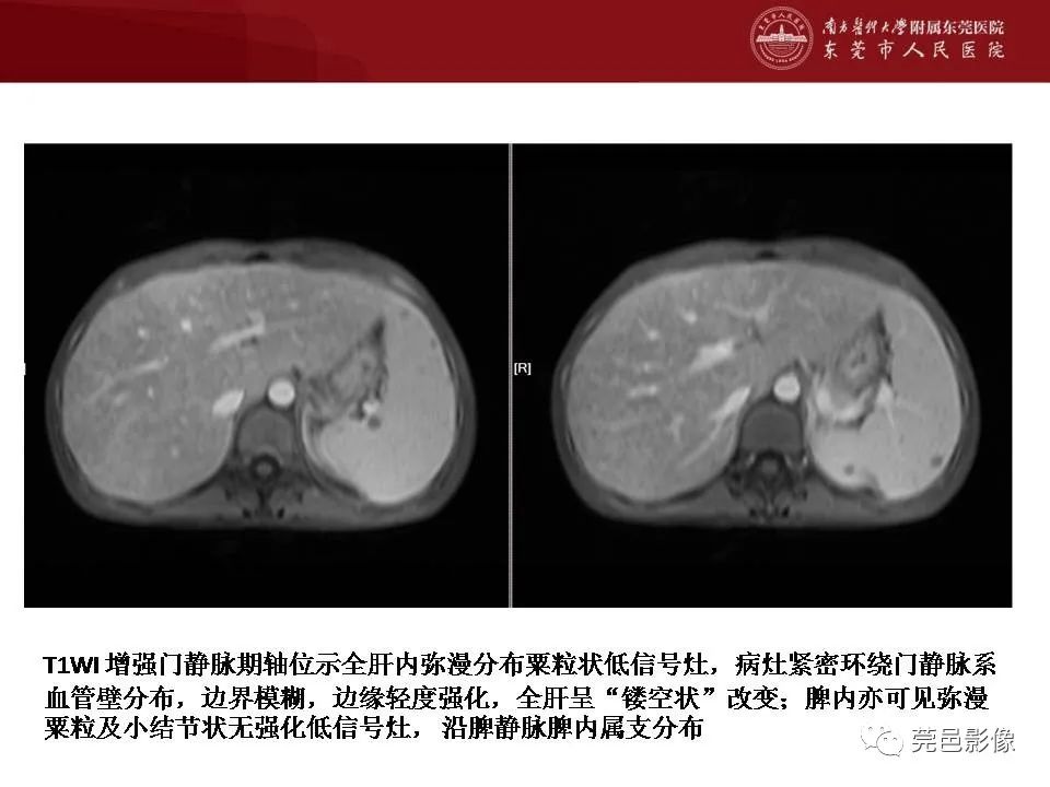 【病例】马尔尼菲蓝状菌感染1例影像学表现-25