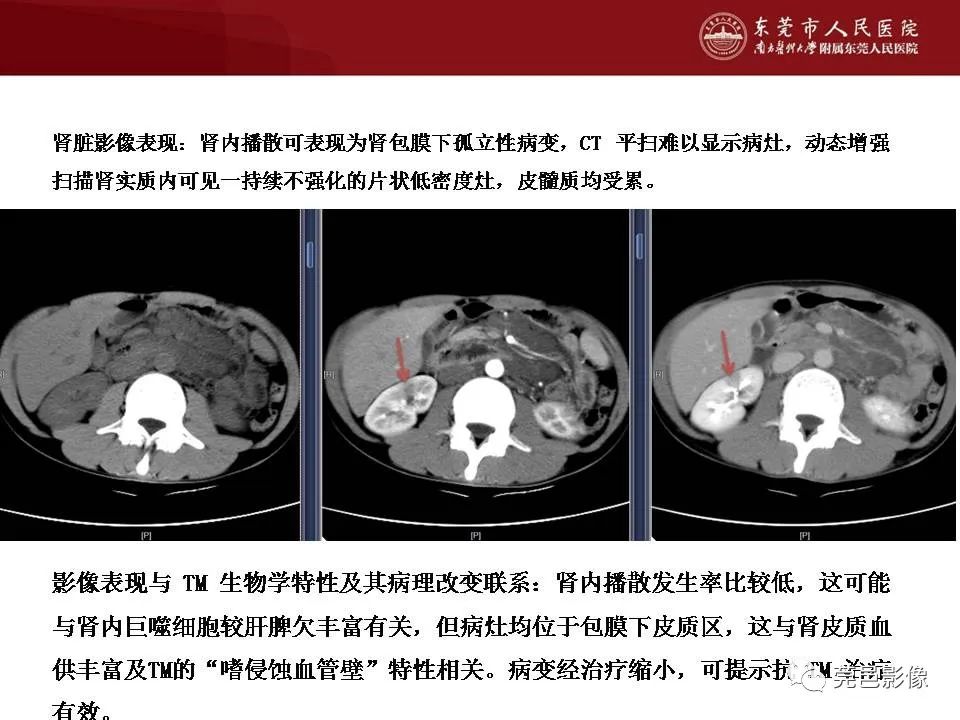 【病例】马尔尼菲蓝状菌感染1例影像学表现-27