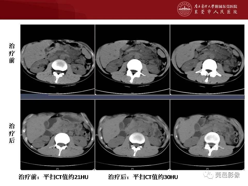 【病例】马尔尼菲蓝状菌感染1例影像学表现-30