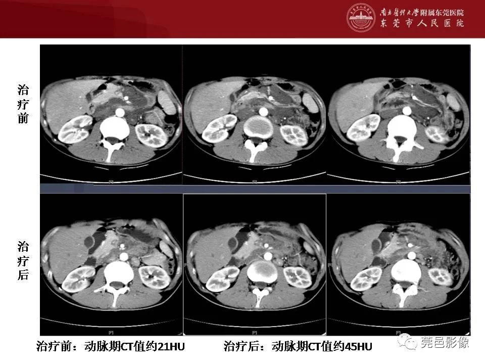 【病例】马尔尼菲蓝状菌感染1例影像学表现-31