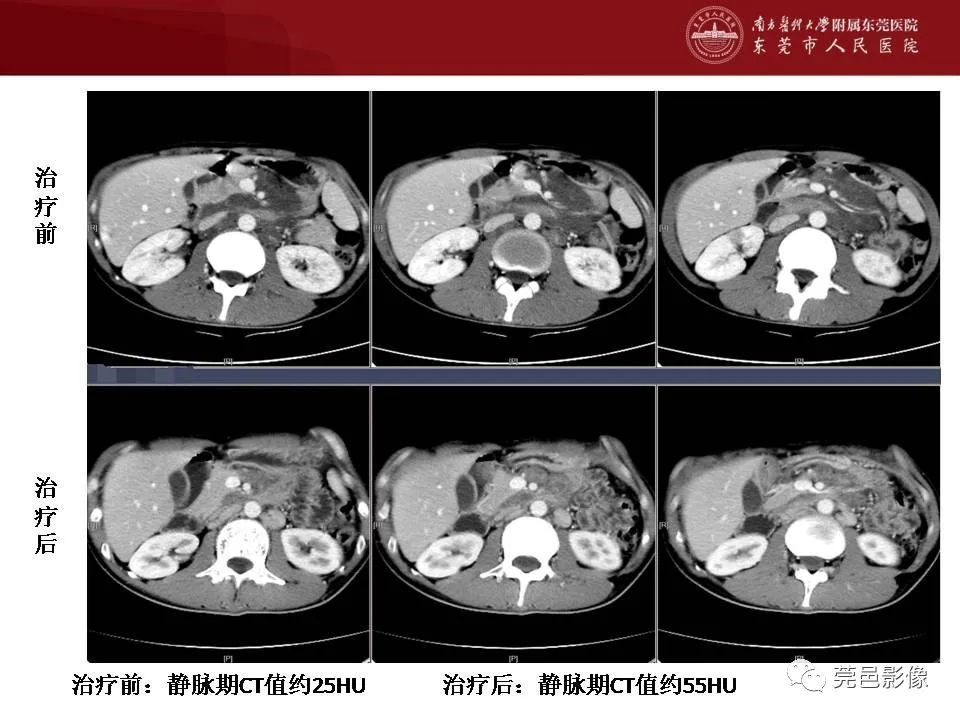 【病例】马尔尼菲蓝状菌感染1例影像学表现-32