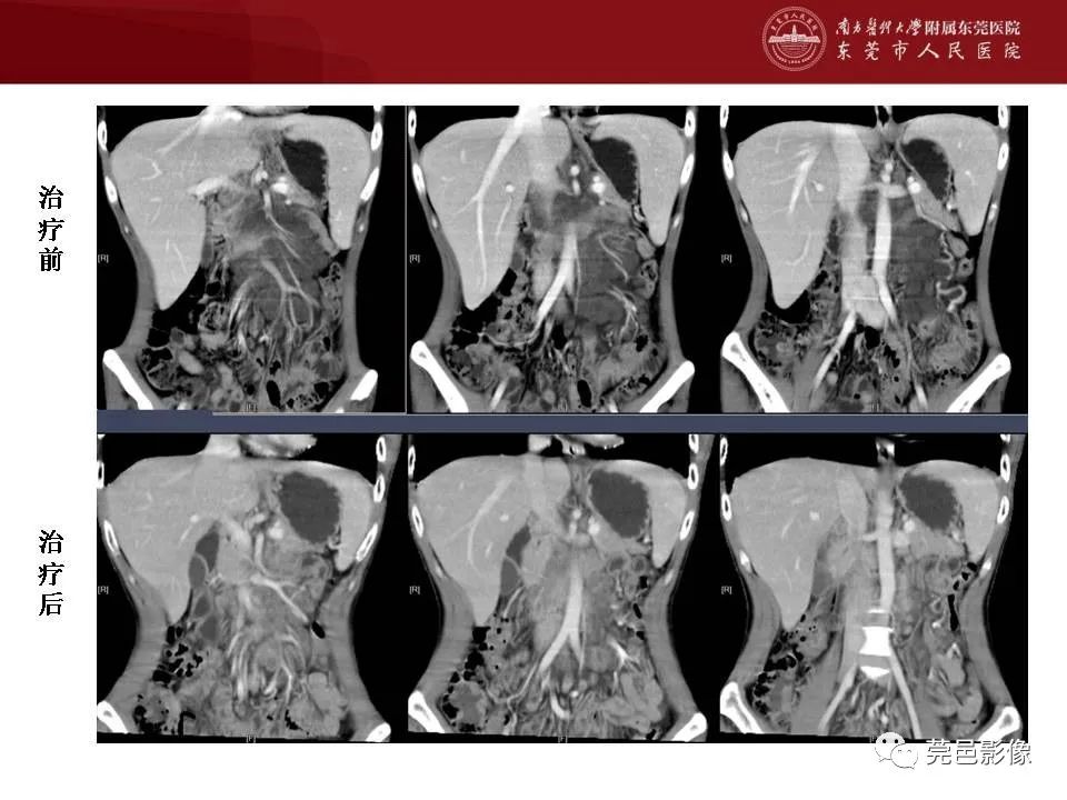 【病例】马尔尼菲蓝状菌感染1例影像学表现-33