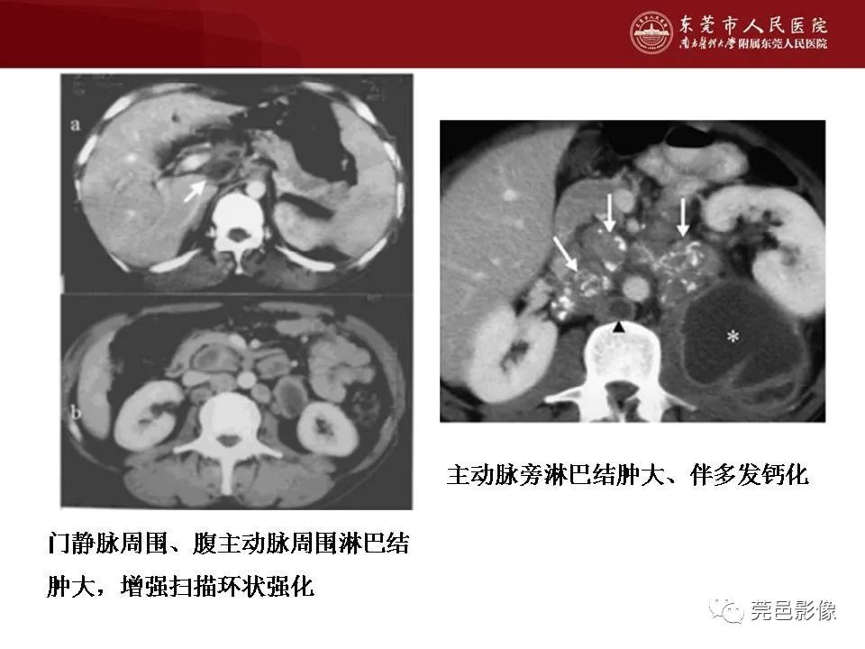 【病例】马尔尼菲蓝状菌感染1例影像学表现-38