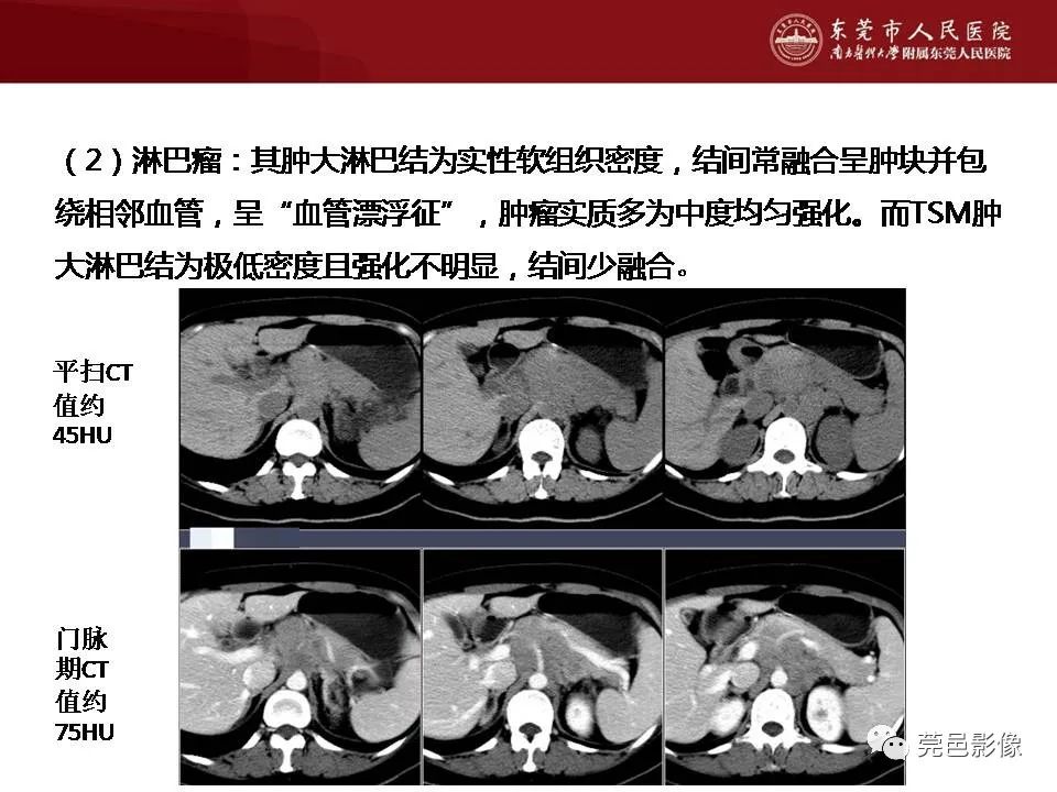 【病例】马尔尼菲蓝状菌感染1例影像学表现-39
