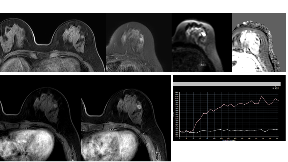 【病例】纤维囊性乳腺病伴纤维腺瘤形成 VS 乳腺增生病并间质硬化-3