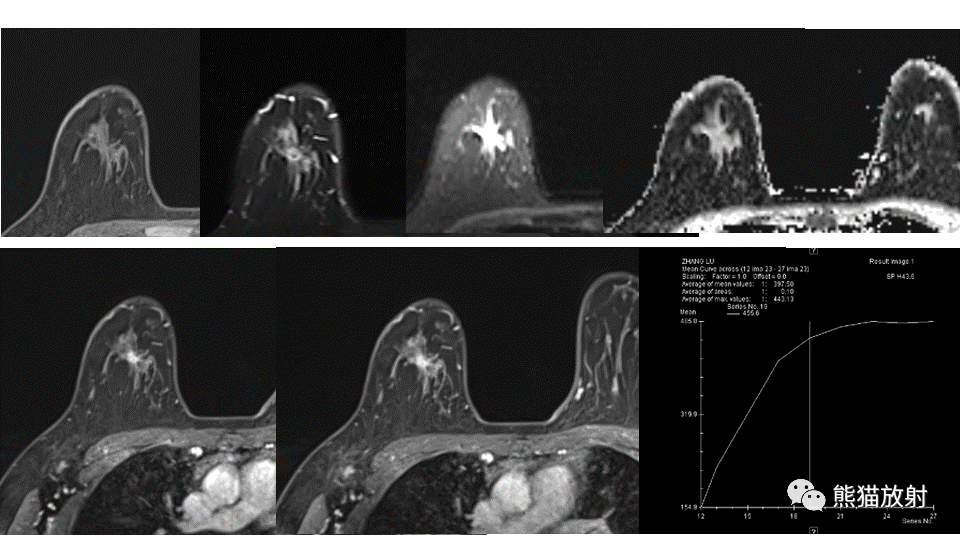 【病例】纤维囊性乳腺病伴纤维腺瘤形成 VS 乳腺增生病并间质硬化-7