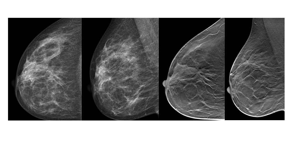 【病例】纤维囊性乳腺病伴纤维腺瘤形成 VS 乳腺增生病并间质硬化-6