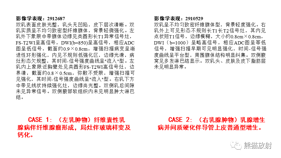 【病例】纤维囊性乳腺病伴纤维腺瘤形成 VS 乳腺增生病并间质硬化-9
