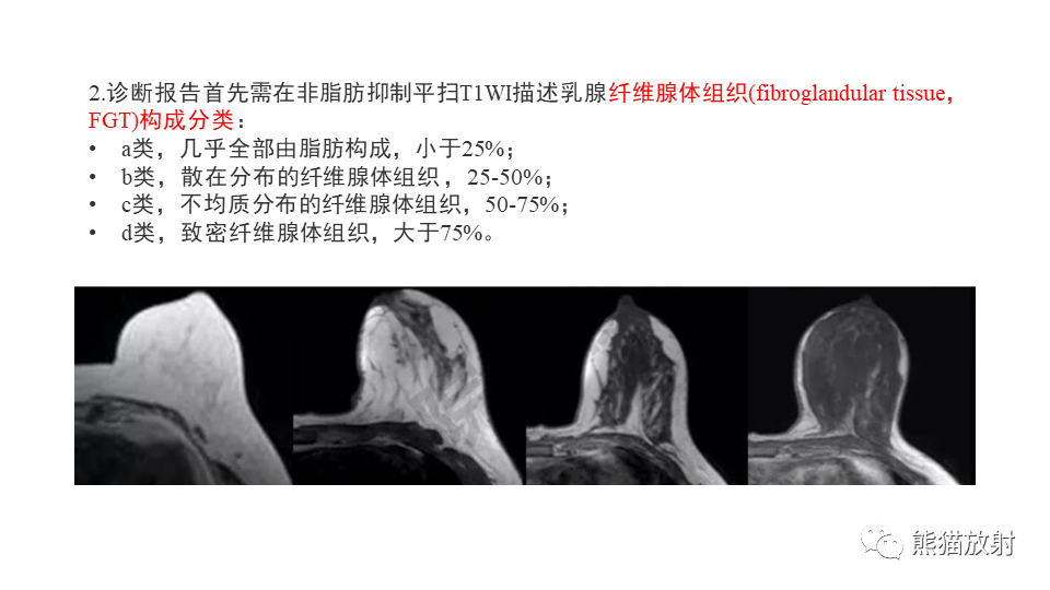 【病例】纤维囊性乳腺病伴纤维腺瘤形成 VS 乳腺增生病并间质硬化-12