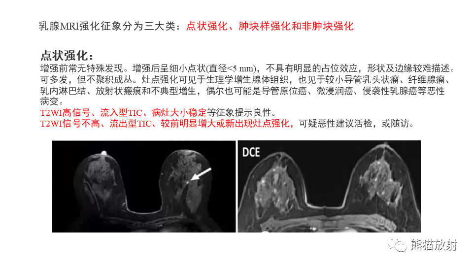 【病例】纤维囊性乳腺病伴纤维腺瘤形成 VS 乳腺增生病并间质硬化-15