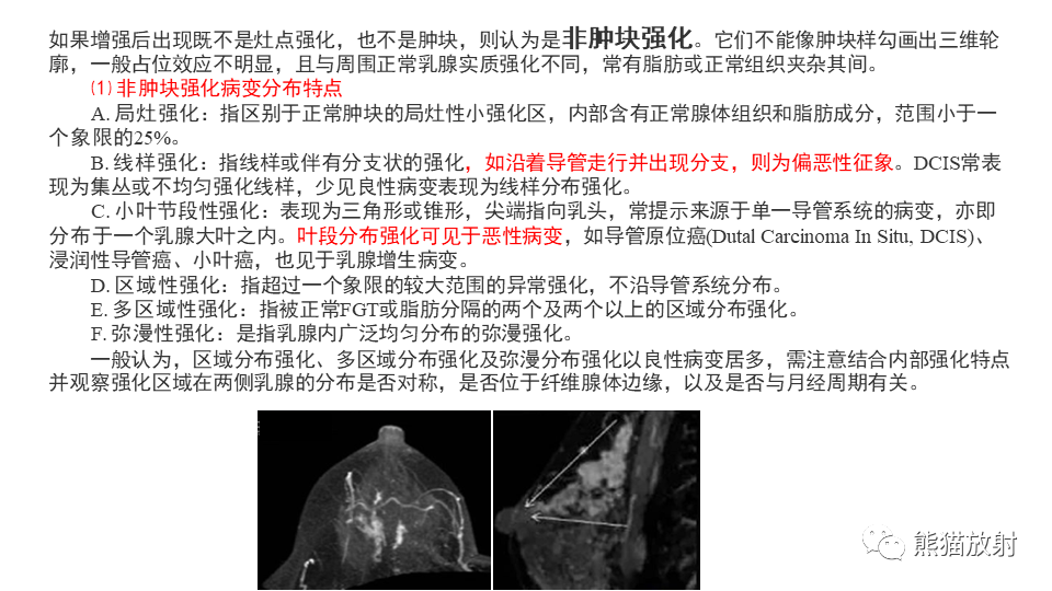 【病例】纤维囊性乳腺病伴纤维腺瘤形成 VS 乳腺增生病并间质硬化-18