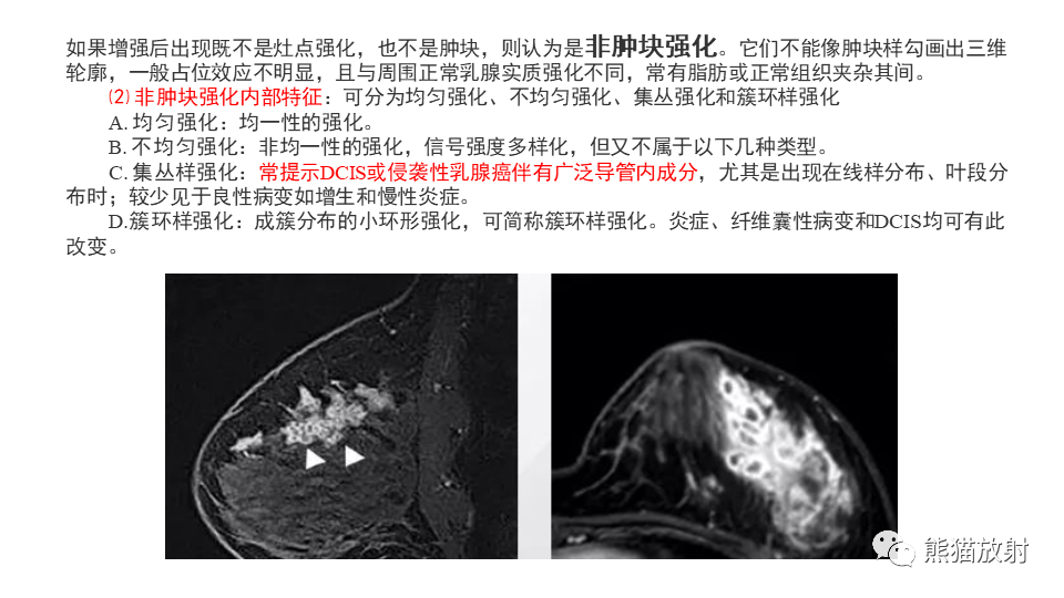 【病例】纤维囊性乳腺病伴纤维腺瘤形成 VS 乳腺增生病并间质硬化-19