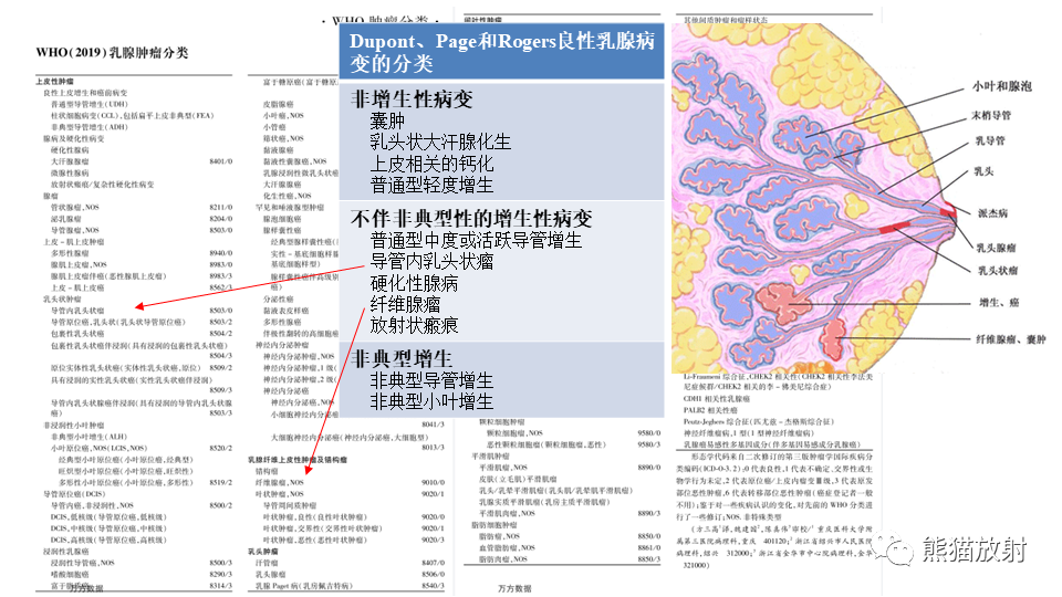 【病例】纤维囊性乳腺病伴纤维腺瘤形成 VS 乳腺增生病并间质硬化-22