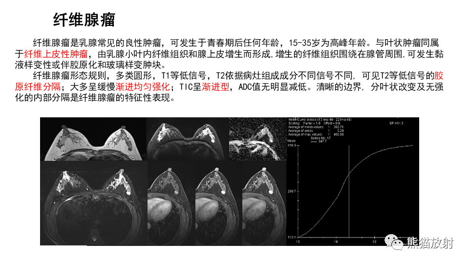 【病例】纤维囊性乳腺病伴纤维腺瘤形成 VS 乳腺增生病并间质硬化-25