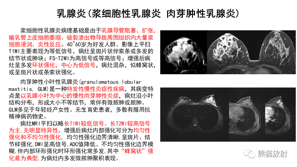 【病例】纤维囊性乳腺病伴纤维腺瘤形成 VS 乳腺增生病并间质硬化-24