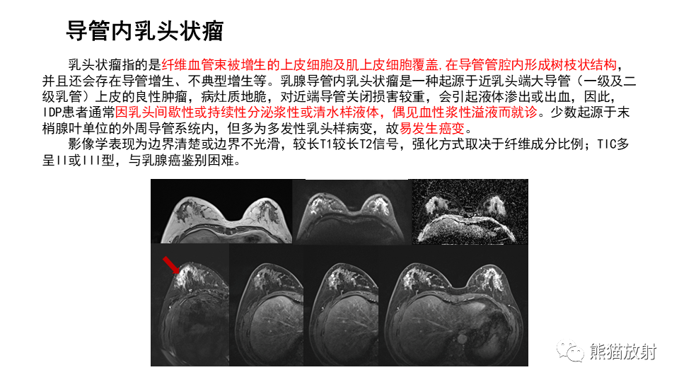 【病例】纤维囊性乳腺病伴纤维腺瘤形成 VS 乳腺增生病并间质硬化-26