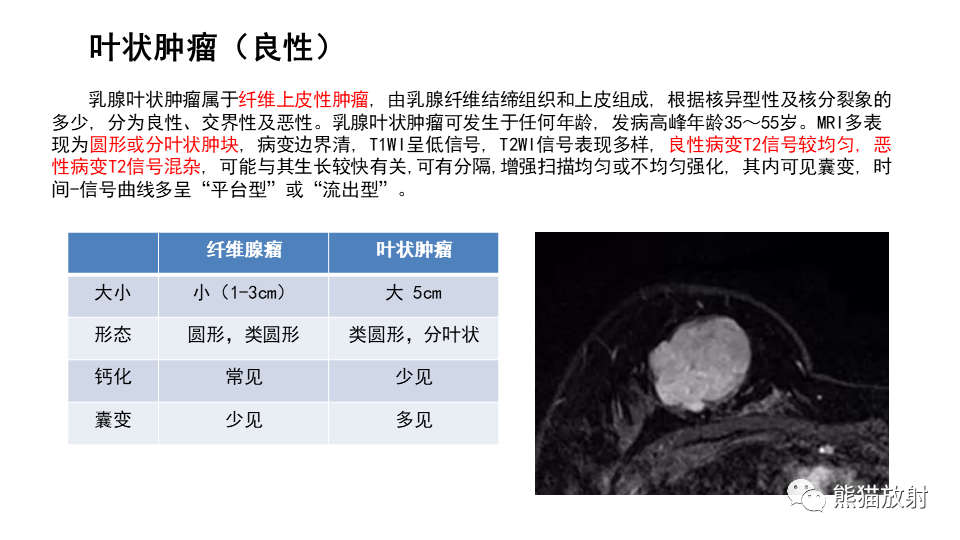 【病例】纤维囊性乳腺病伴纤维腺瘤形成 VS 乳腺增生病并间质硬化-27