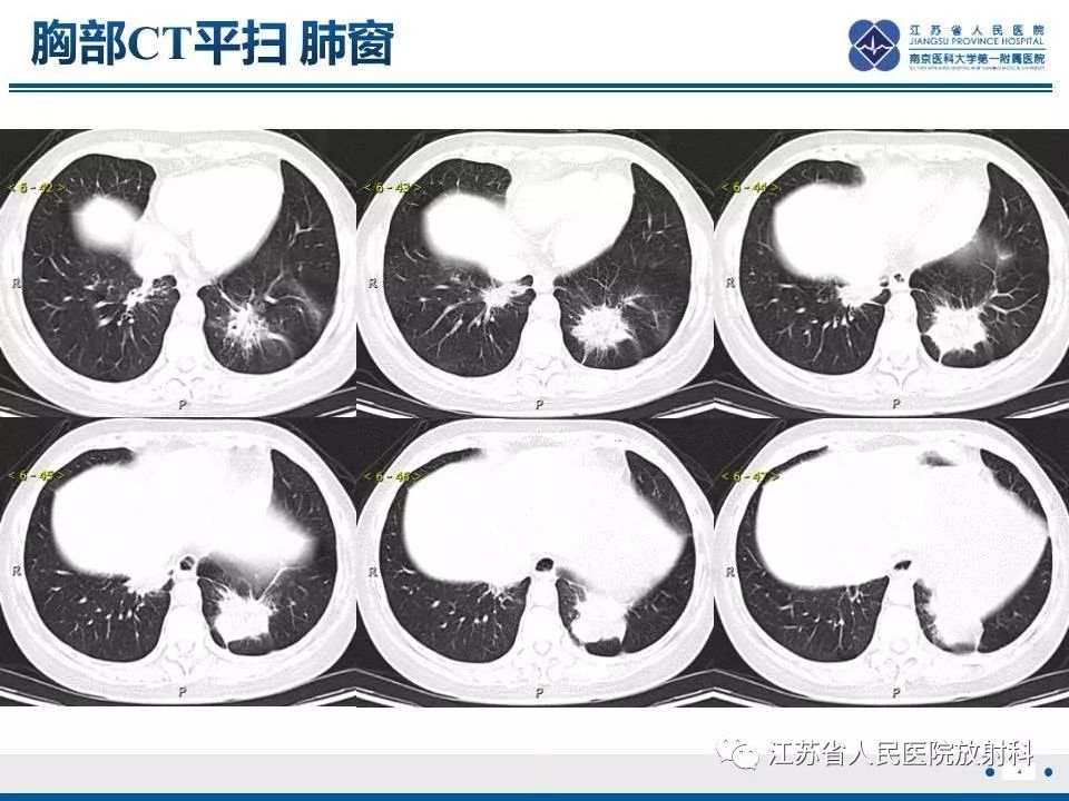 【PPT】脂质性肺炎-4