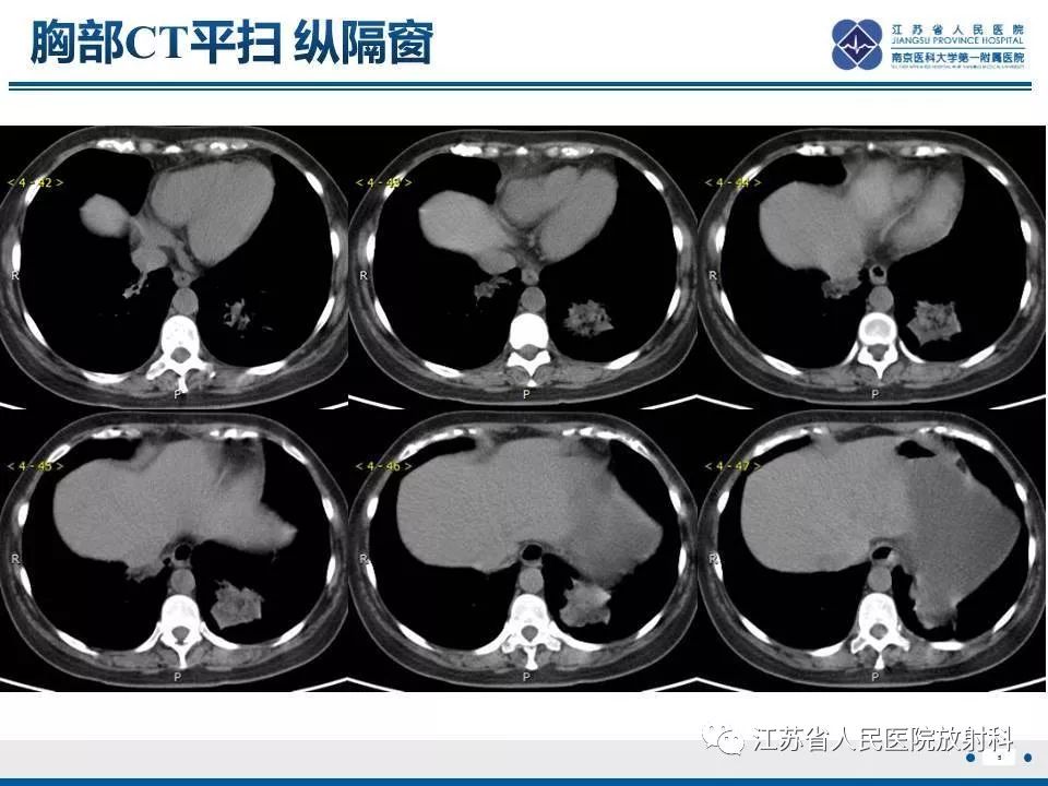 【PPT】脂质性肺炎-5