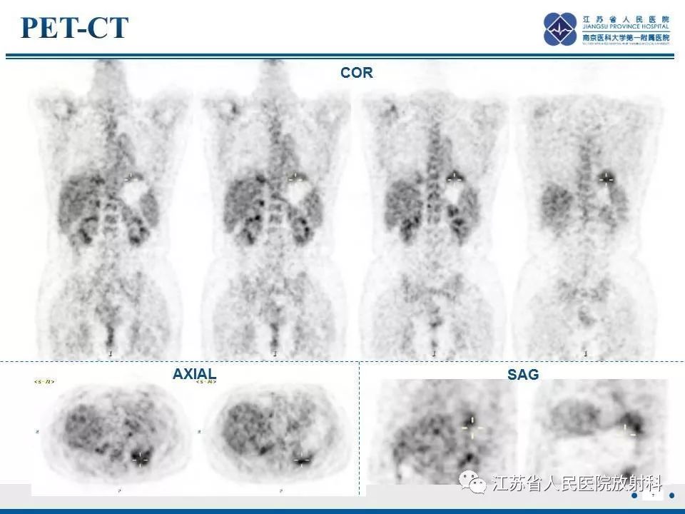 【PPT】脂质性肺炎-7
