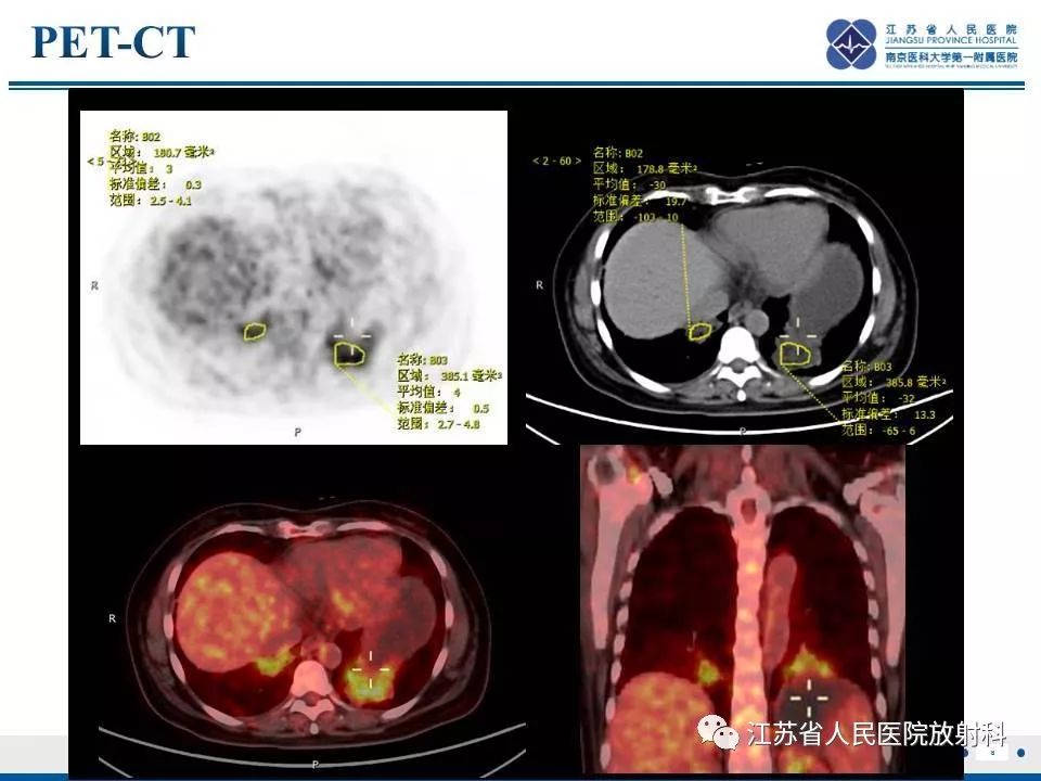 【PPT】脂质性肺炎-8