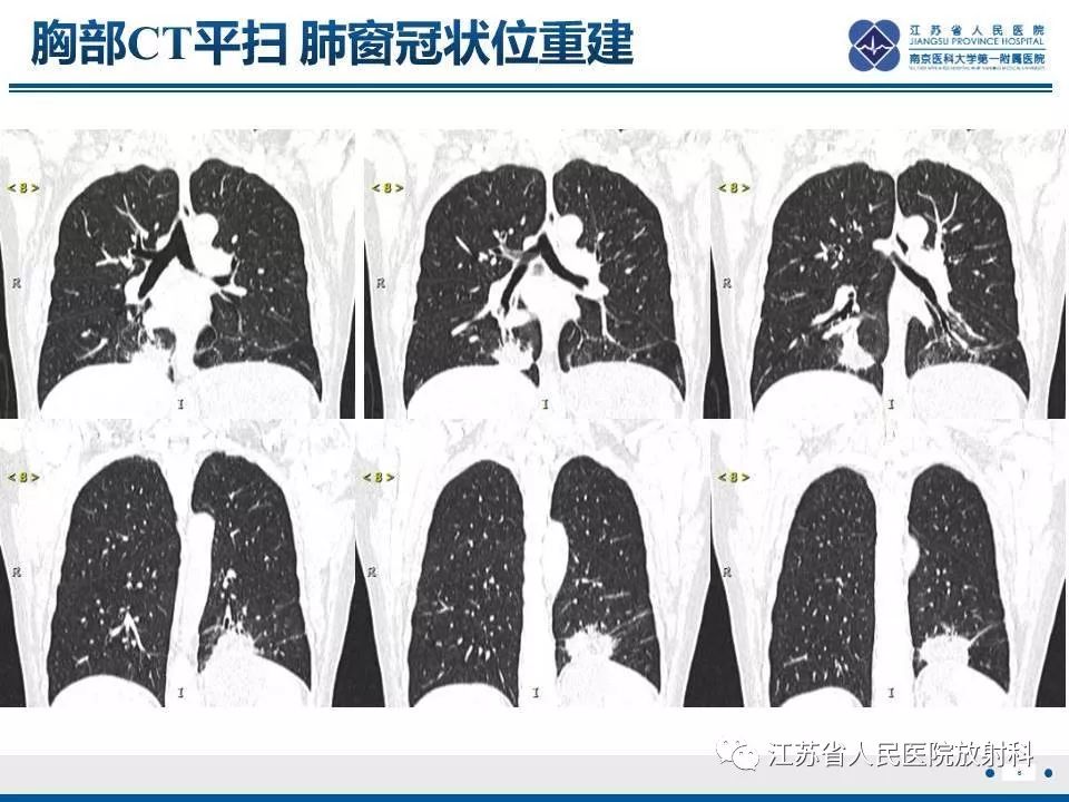 【PPT】脂质性肺炎-6
