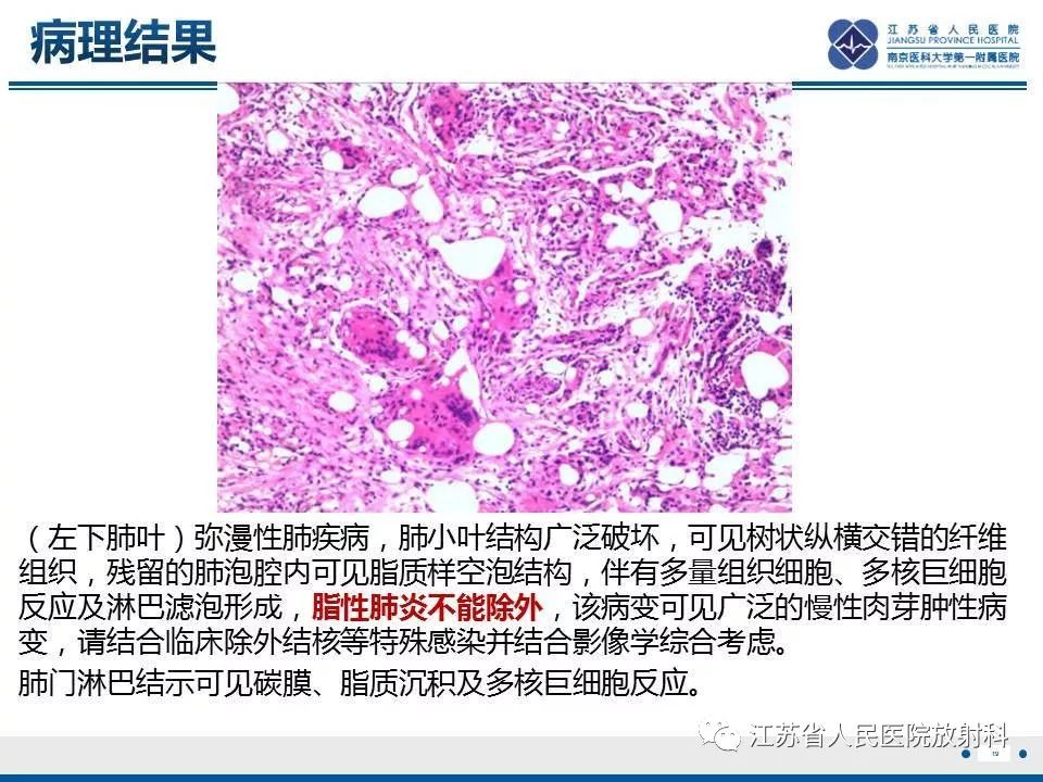 【PPT】脂质性肺炎-19