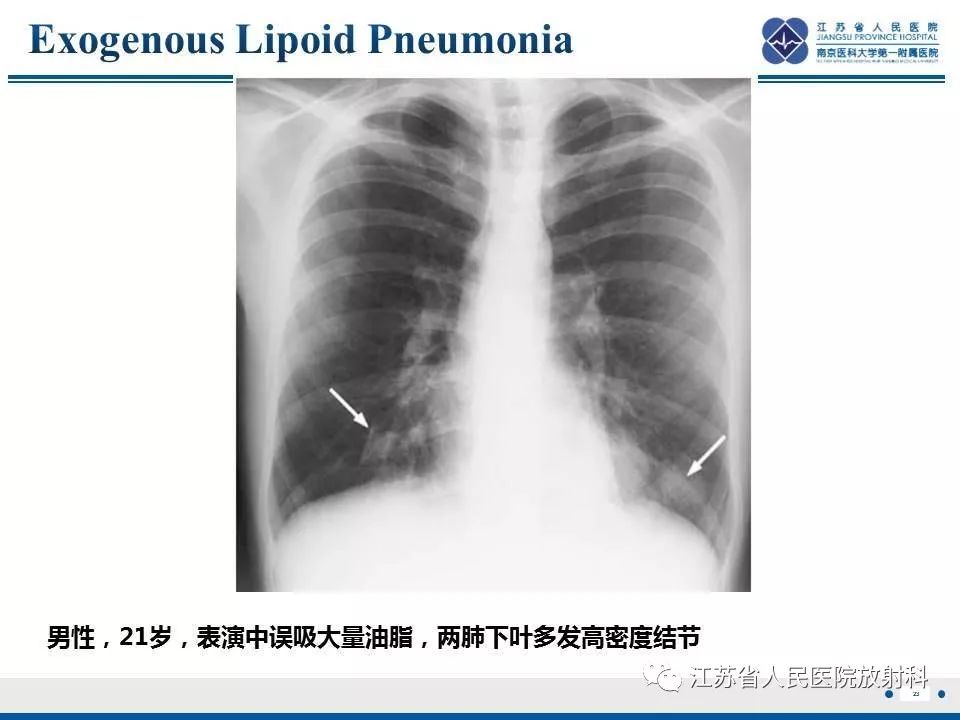 【PPT】脂质性肺炎-23