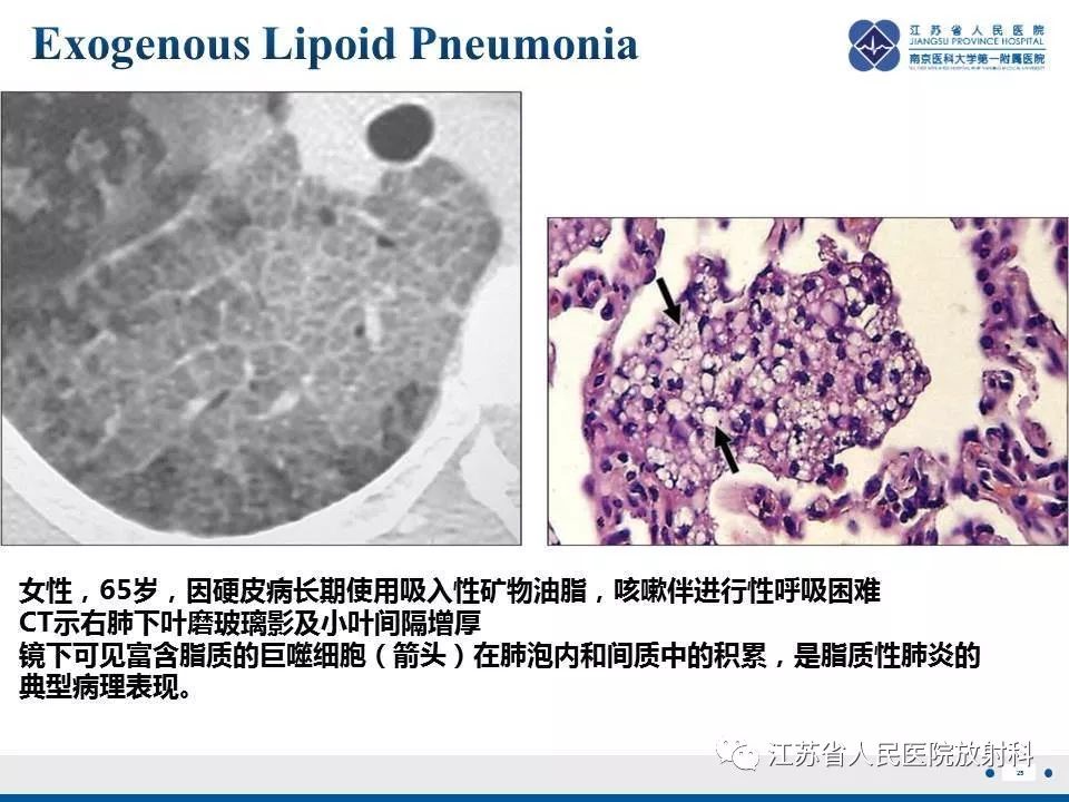 【PPT】脂质性肺炎-25