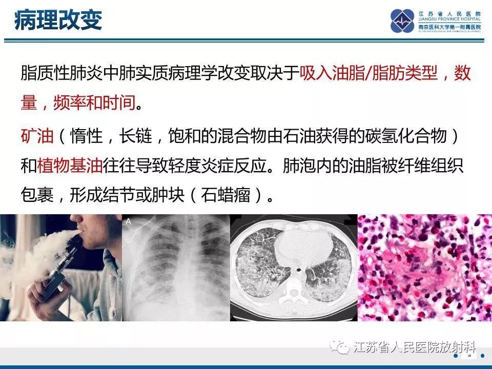 【PPT】脂质性肺炎-26