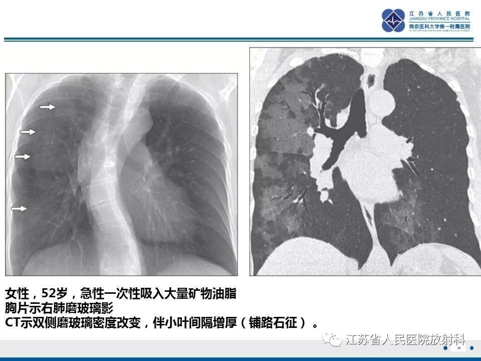 【PPT】脂质性肺炎-30