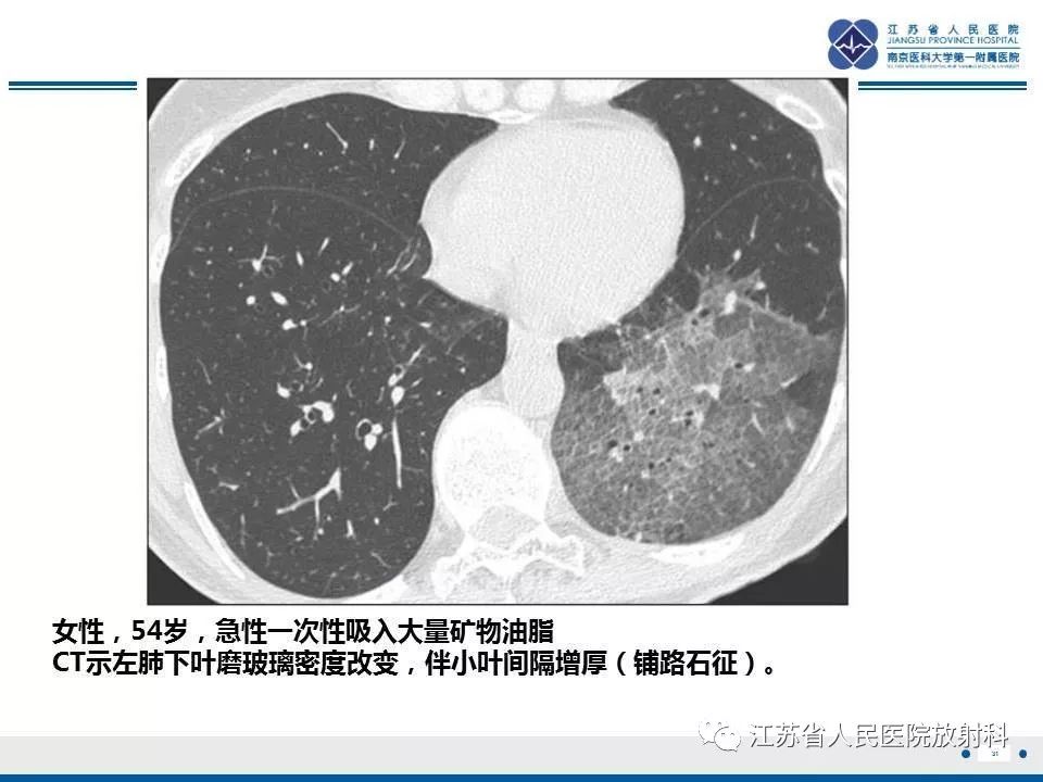 【PPT】脂质性肺炎-31