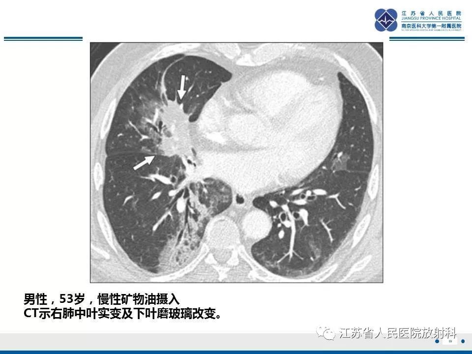 【PPT】脂质性肺炎-33