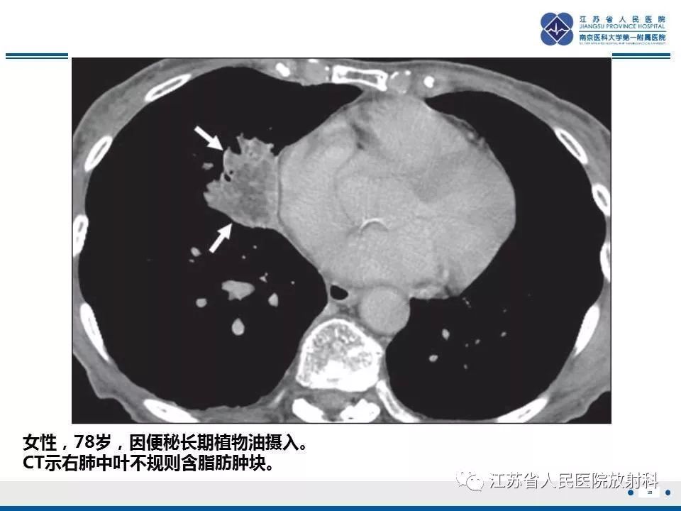 【PPT】脂质性肺炎-35