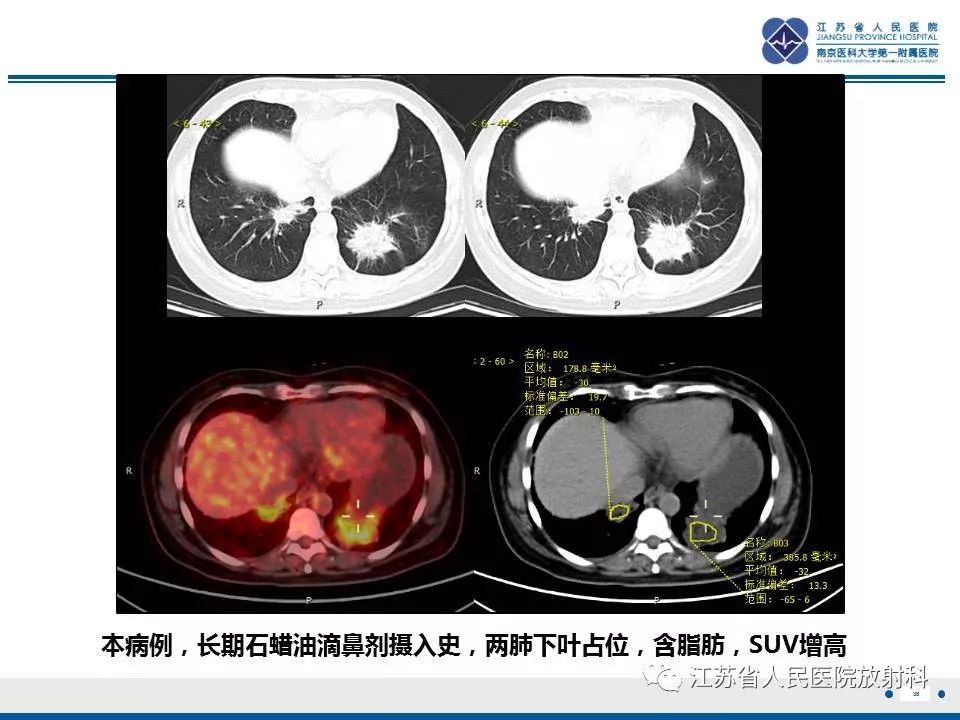 【PPT】脂质性肺炎-36