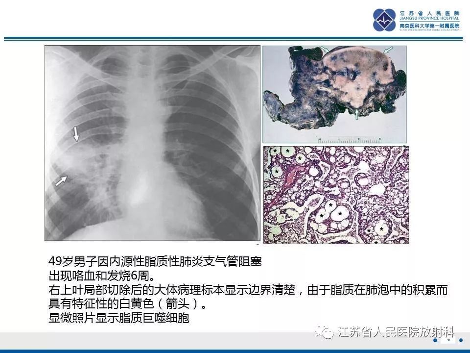 【PPT】脂质性肺炎-38