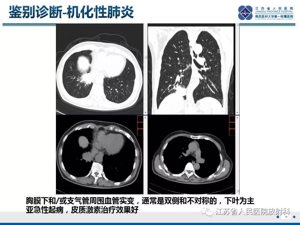 【PPT】脂质性肺炎-39