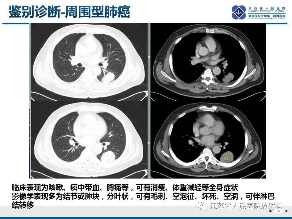【PPT】脂质性肺炎-40