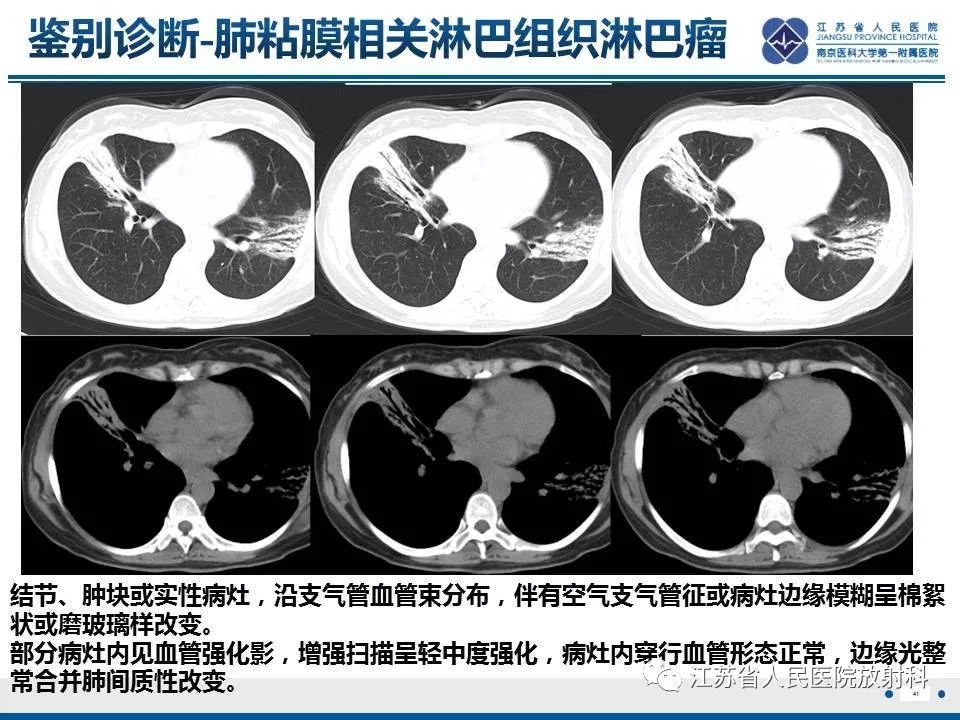 【PPT】脂质性肺炎-41