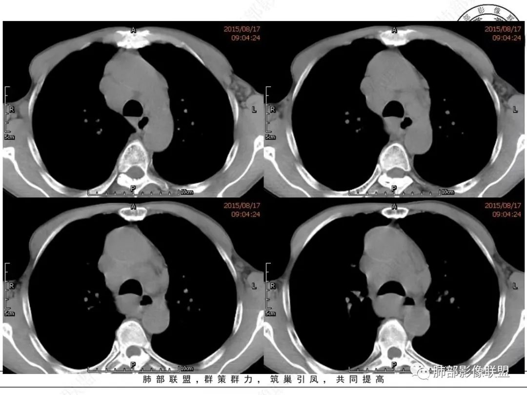 【病例】小细胞肺癌？套细胞淋巴瘤？-5