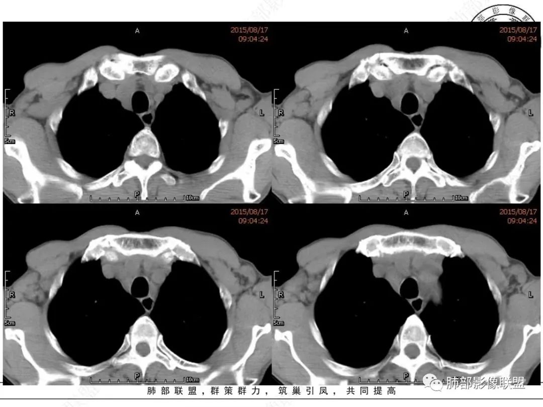 【病例】小细胞肺癌？套细胞淋巴瘤？-3