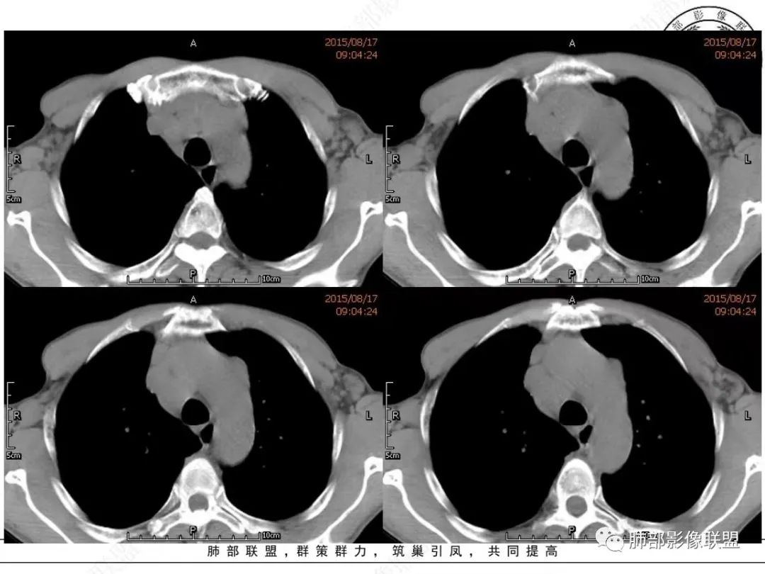 【病例】小细胞肺癌？套细胞淋巴瘤？-4