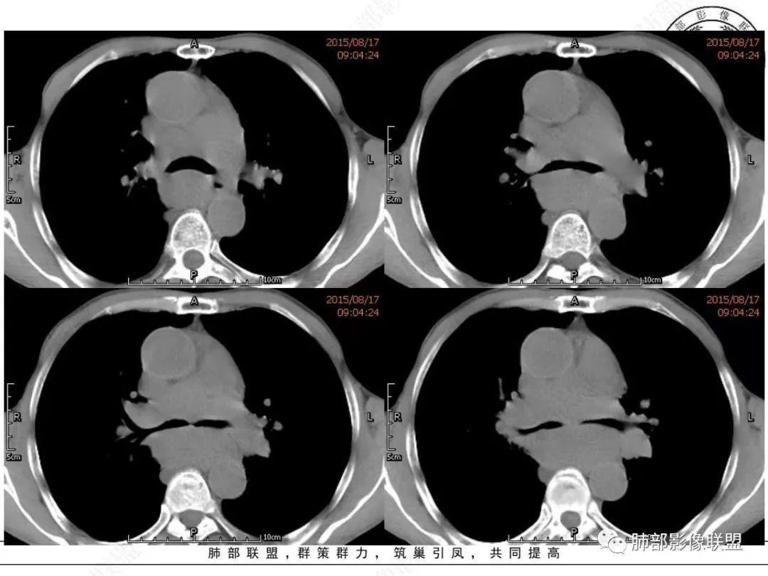 【病例】小细胞肺癌？套细胞淋巴瘤？-6