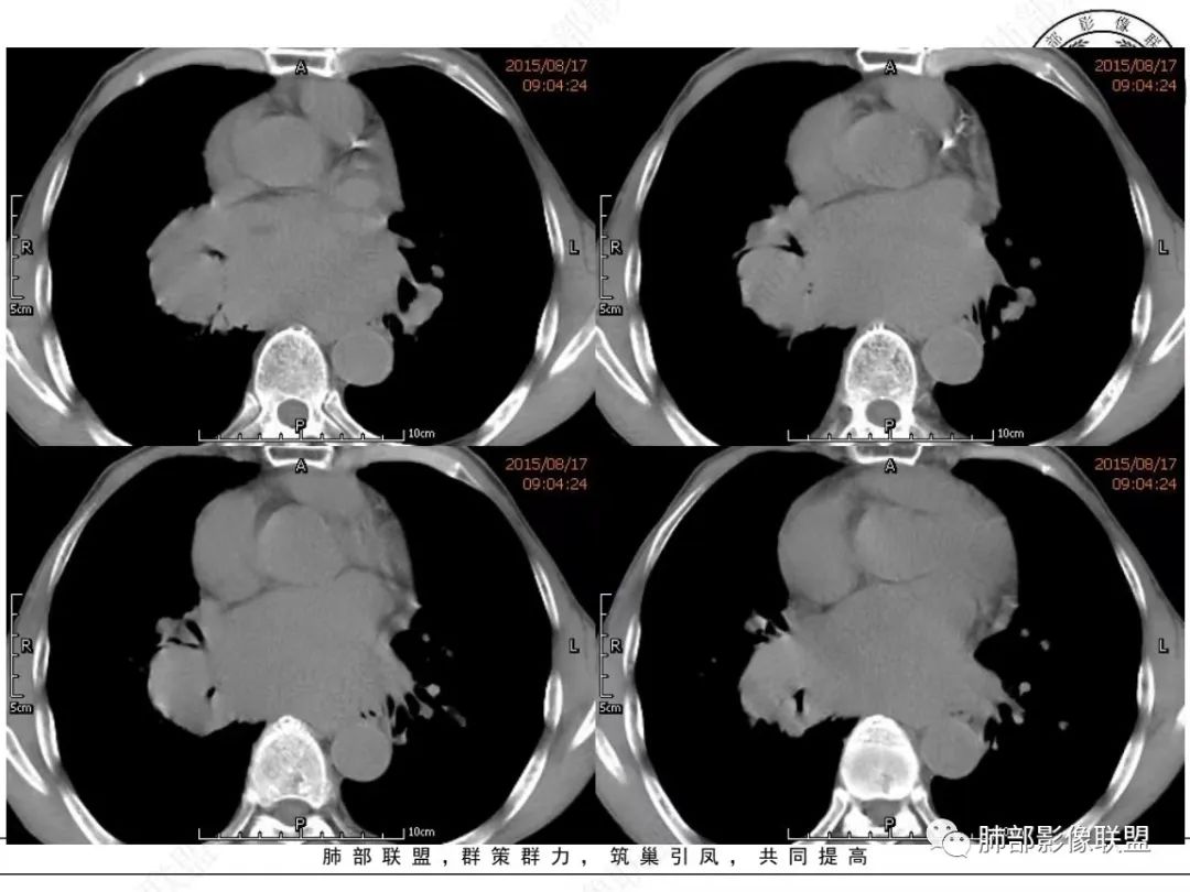 【病例】小细胞肺癌？套细胞淋巴瘤？-8