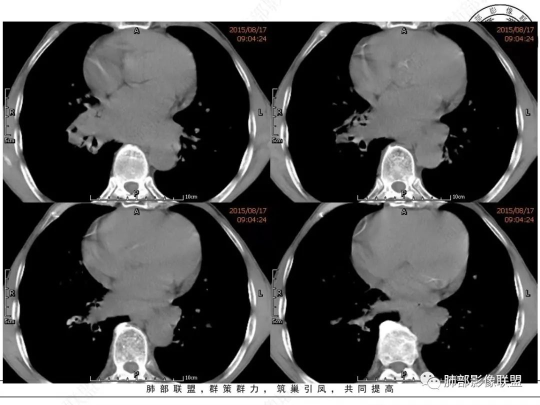 【病例】小细胞肺癌？套细胞淋巴瘤？-9