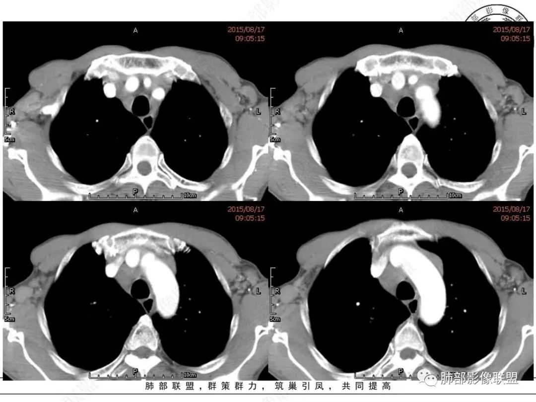 【病例】小细胞肺癌？套细胞淋巴瘤？-10