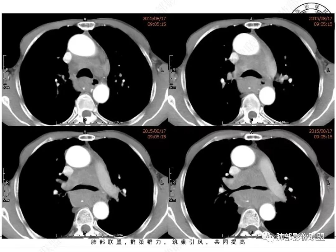 【病例】小细胞肺癌？套细胞淋巴瘤？-12