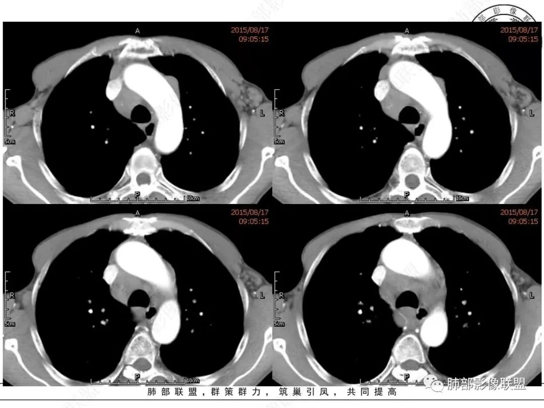 【病例】小细胞肺癌？套细胞淋巴瘤？-11