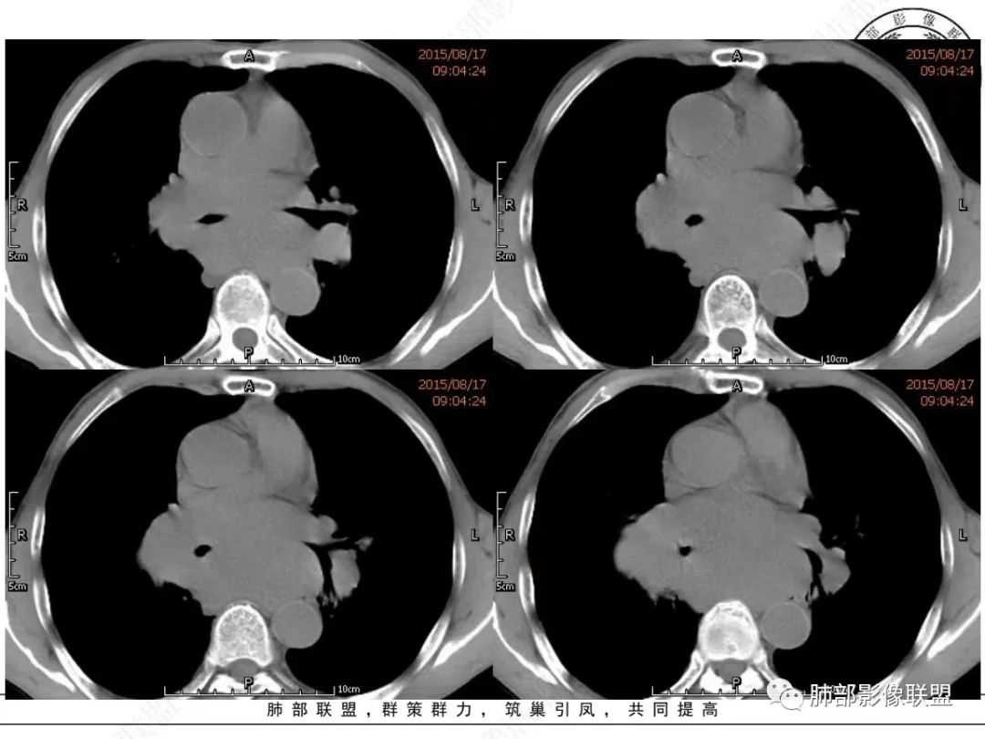 【病例】小细胞肺癌？套细胞淋巴瘤？-7